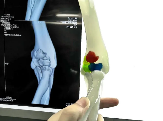 3D打印彩色手术手板模型