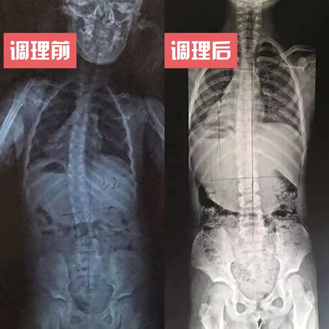 3D打印脊柱模型作为诊疗的依据，治疗患者们的严重脊柱侧弯