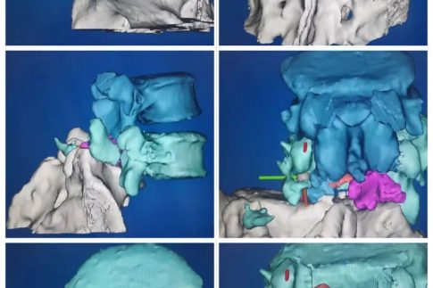 3D打印制作脊柱模型，可以让更加直观、立体地了解患者的病情，并制定相应的手术方案或者矫正治疗方案。.webp