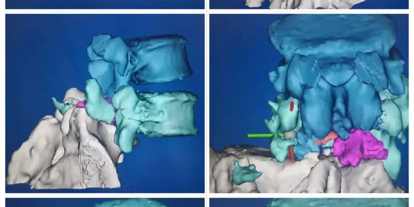 3D打印制作脊柱模型，可以让更加直观、立体地了解患者的病情，并制定相应的手术方案或者矫正治疗方案。.webp