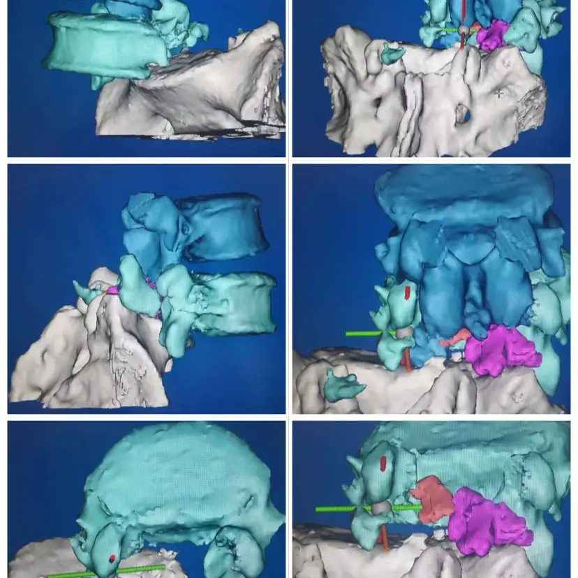 3D打印制作脊柱模型，可以让更加直观、立体地了解患者的病情，并制定相应的手术方案或者矫正治疗方案。.webp