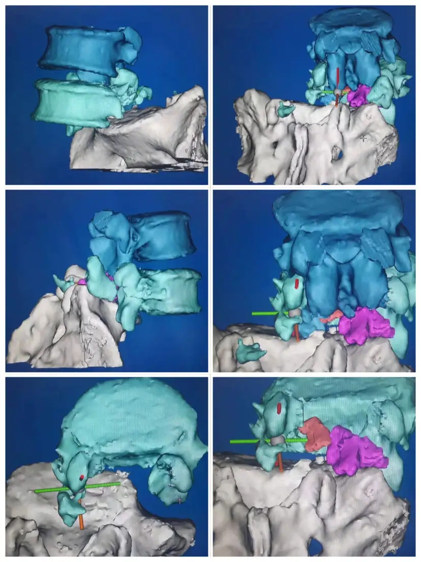 3D打印制作脊柱模型，可以让更加直观、立体地了解患者的病情，并制定相应的手术方案或者矫正治疗方案。.webp